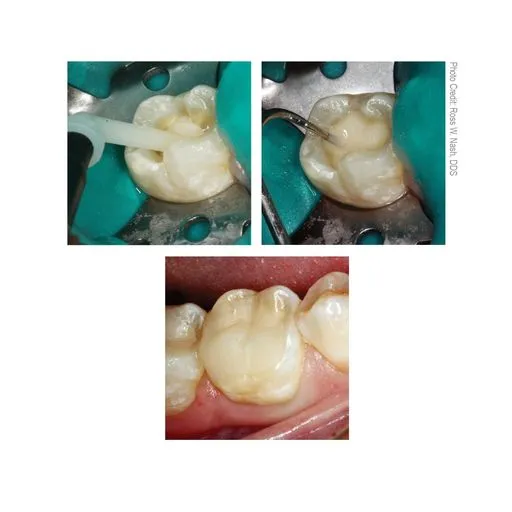 HyperFIL Bulk-Fill Composite (Enamel Shade - A1/B1)